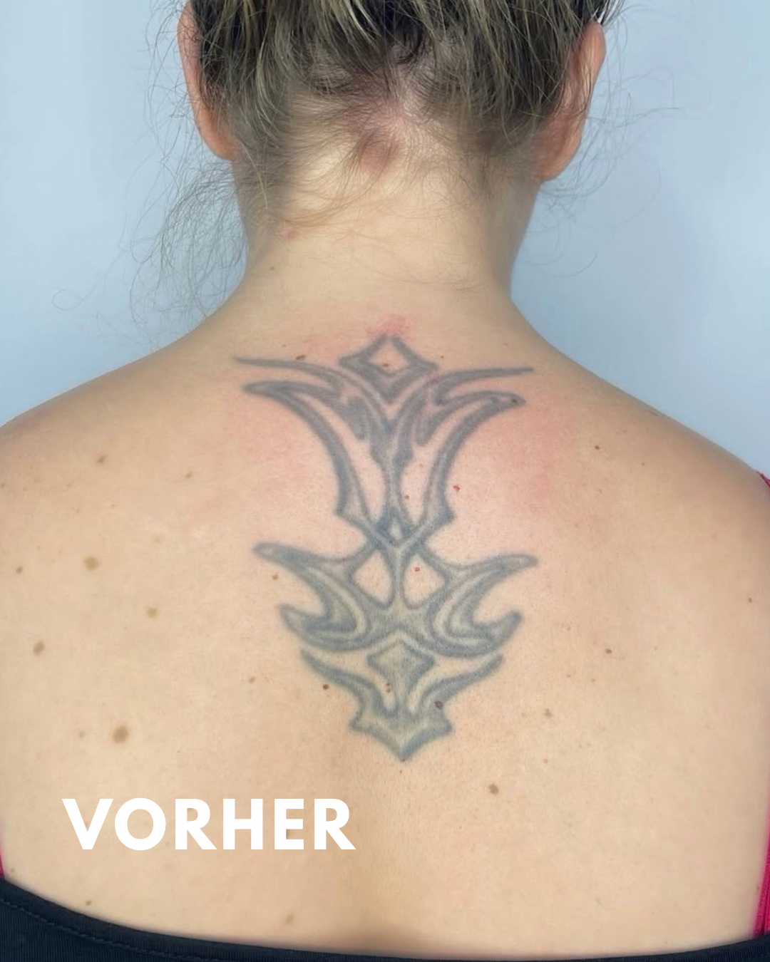 Vorher – Rücken